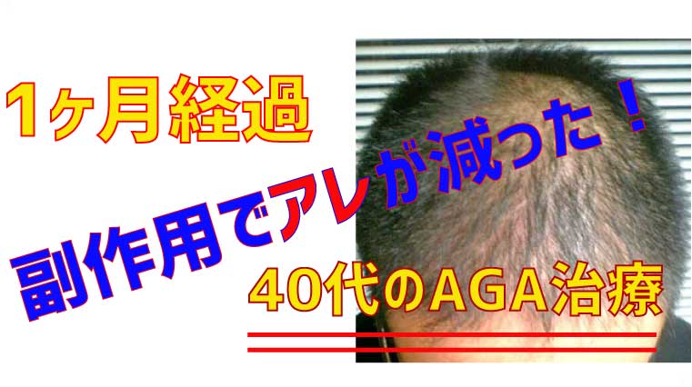 AGAの効果は40代でもある？【治療から1ヶ月経過】