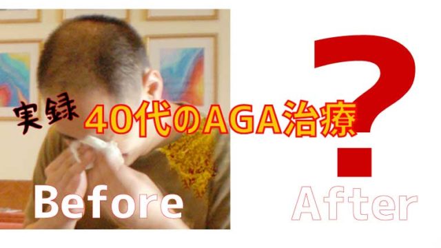 AGAって何ですか？40代でハゲたらどうしたらいいか分からない