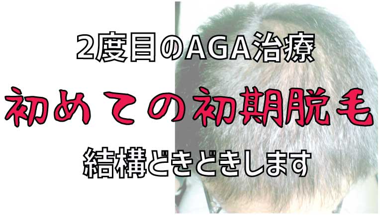 AGA治療は何度でも薄毛が治るのか検証【2ヶ月目】