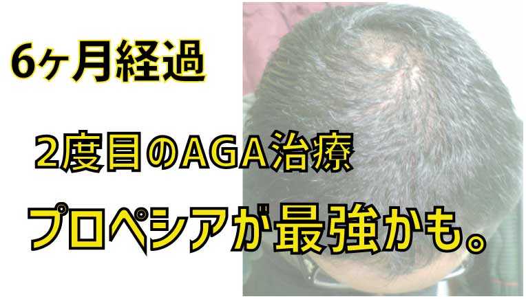 プロペシアがハゲに一番効果あると思う【2回目のAGA治療6ヶ月】